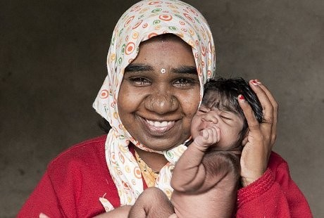 Bayi Ini Generasi Ketiga dalam Keluarga yang Idap Sindrom Serigala