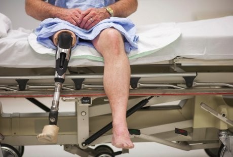 Kisah Orang-orang yang Ciptakan Organ Prostetik Sendiri