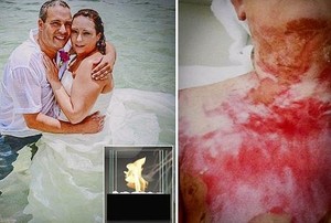 Gara-gara Lilin, Anna Derita Luka Bakar Parah dan Hampir Meninggal