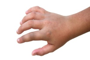 Jari Tangan Tiba-tiba Bengkak Seperti Sosis? Bisa Jadi Itu Tanda Artritis Reumatoid