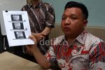 Kondisi Mahasiswi Binus Pasca Disiram Air Keras