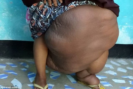 Wanita Berkaki Balon, Menggelembung Hingga 31,7 Kg karena Elephantiasis