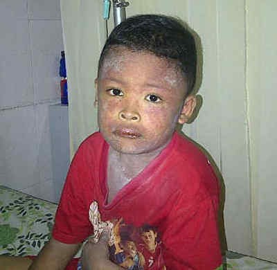 Diduga Keracunan Obat, Tubuh Putra Muncul Bintik dan Mulut Keluar Darah