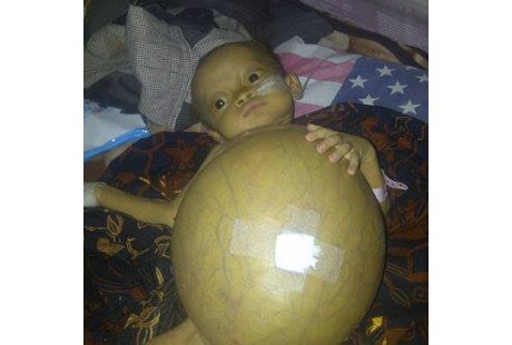 Mengenal Sirosis Hepatik, Penyebab Perut Bayi Akilah Membengkak