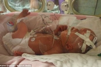 Inilah Kaydence Theriault, Bocah dengan Bentuk Kepala Tak Beraturan