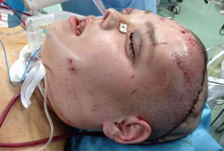 Wajah Berantakan karena Tumor, Wanita Ini Akhirnya Dapat Transplantasi