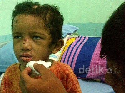 Adit Bocah Penuh Luka Dirawat di RSUD Bangkinang