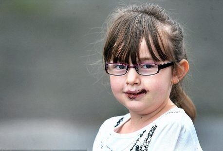 Tiba-Tiba Diserang Anjing, Bibir Bocah Ini Koyak Parah