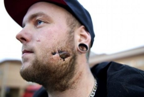 Pria Bermuka Kaca, Ada Serpihan Botol yang Bersarang di Pipinya