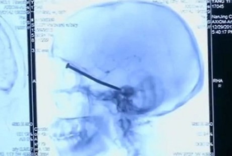Lagi-lagi di China, Pasien Tak Sadar Ada Paku Menancap di Kepala