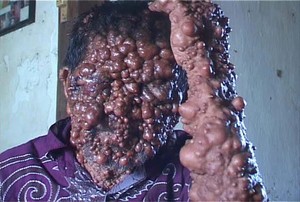 Upaya Slamet Bebas dari Tumor: Jual Tanah Hingga Terapi Daun Sirih Merah