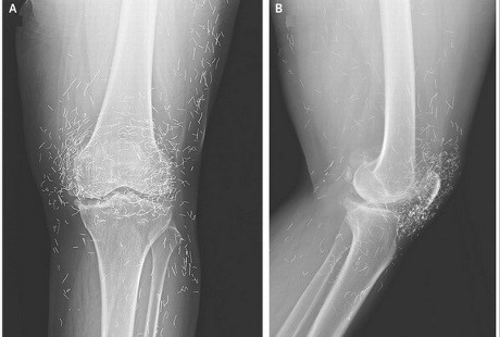 Kokrak jinsiy aloqada osadimi?