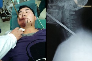 Mengerikan! Batang Logam Tusuk Mulut dan Tembus Punggung Pekerja Bangunan
