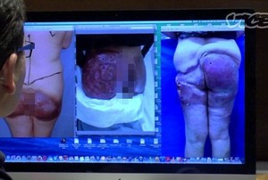 Wanita Berpantat Bawang, Bokongnya Berwarna Ungu Akibat Suntik Ilegal