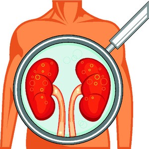 Studi: Diet Tinggi Protein Tingkatkan Risiko Penyakit Batu Ginjal