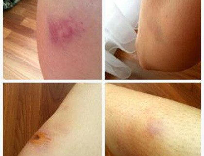 Kesurupan di Lokasi Syuting, Roro Fitria Alami Lebam