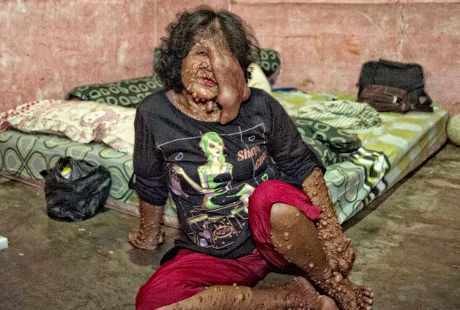 Wajah Meleleh karena Tumor, Sarotin Tinggalkan Kampungnya di Bandung