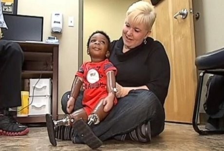 Diberi Kaki Palsu, Balita 18 Bulan Ini Lakukan Langkah Pertamanya