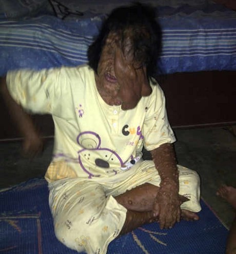 Mengenal Neurofibromatosis, Penyakit yang Membuat Wajah Sarotin Meleleh