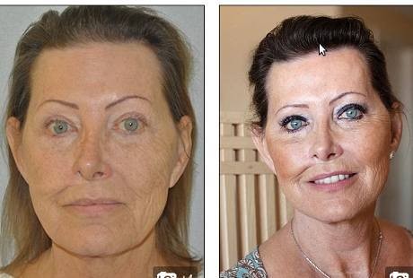 Kena Kanker Kulit, Kini Jackie Terlihat Lebih Muda Usai Operasi Plastik