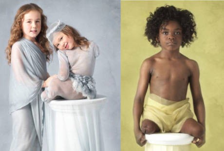 Fotografer Luncurkan Foto-foto Survivor Meningitis Cilik untuk Kampanye