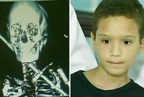 Bocah Ajaib, Bertahan Hidup Meski Leher Ditembus Logam Sepanjang 61 Cm