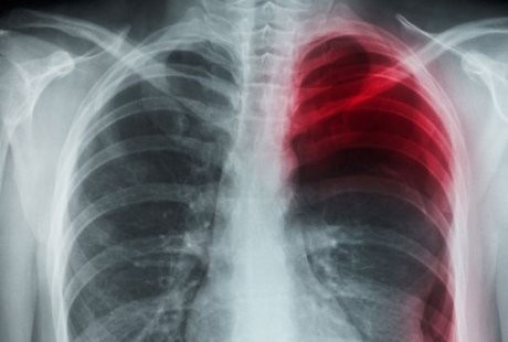 Gara-gara Menguap Terlalu Keras, Paru-paru Pria Ini Jadi Kolaps