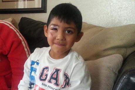 Kepala Terjepit di Eskalator, Wajah dan Kelopak Mata Bocah Ini Luka-luka