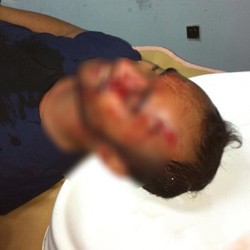 Jadi Korban Pemukulan, Vokalis Pure Saturday Bersimbah Darah