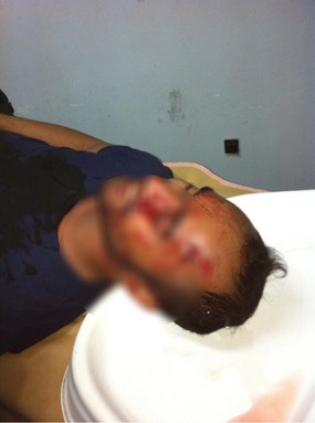 Jadi Korban Pemukulan, Vokalis Pure Saturday Bersimbah Darah