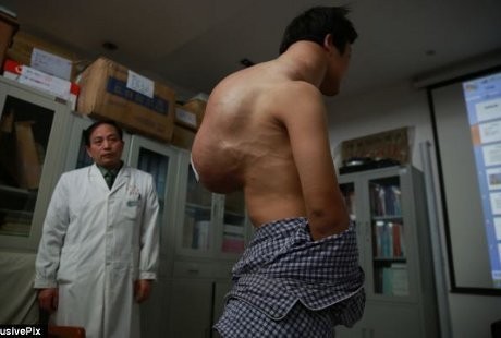 Tumor 10 Kg Bergelayut di Punggung Pemuda Ini Sejak 10 Tahun Lalu