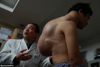 Yang Xiao, Pemuda yang Hidup dengan Tumor 10 Kg Selama Sepuluh Tahun