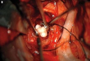 Astaga! Gigi Ditemukan di Otak Bayi dengan Tumor Ini