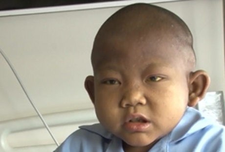 Kisah Hafidz, Bocah dengan Allegile Syndrome yang Sukses Transplantasi Hati