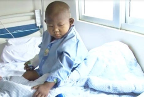 Mengenal Allegile Syndrome, Sindrom Langka yang Diderita Hafidz