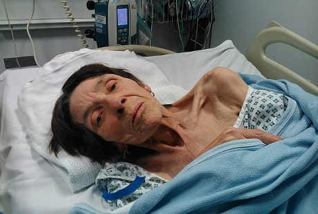 Kena Penyakit Misterius, Wanita Ini Mendadak Kurus Kering dalam 3 Bulan