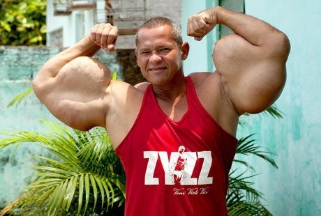 Pemilik Bisep Terbesar di Brasil, Otot Gede karena Suntik Minyak dan Alkohol