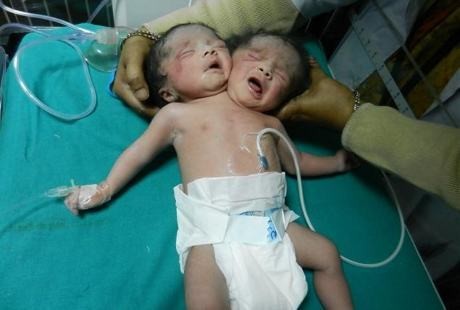 Kasihan, Bayi Ini Lahir dengan Dua Kepala