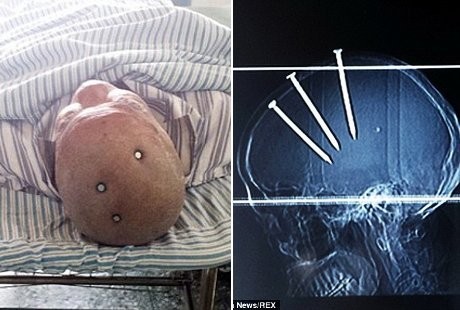 Pria Kepala Beton, Masih Hidup Meski Tengkorak Ditancap 3 Paku Ukuran 10 Cm