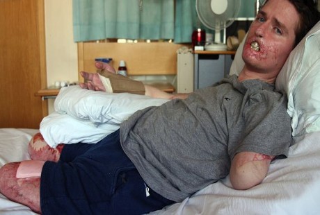 Bakteri Pemakan Daging Gerogoti Kaki, Lengan, dan Wajah Pria Ini