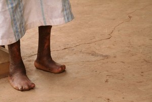 Dianggap Memalukan, Pasien Kusta Sulit Menikah dan Dapat Pekerjaan