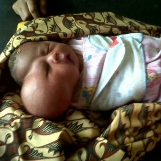 Bayi Ini Memiliki 2 Wajah dan Butuh Bantuan untuk Operasi
