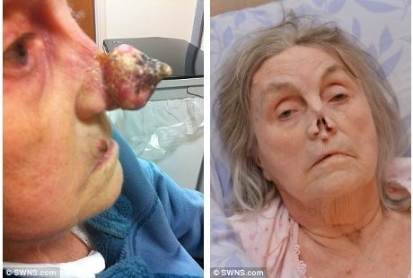 Nenek Berjuluk Pinocchio, Ternyata Ada Tumor Ganas di Hidung Panjangnya