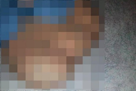 Punya Tiga Testis, Pria Ini Pamerkan Fotonya di Jejaring Sosial