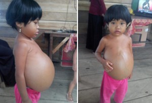 Tak Ada Biaya, Bocah dengan Perut Membesar di Gorontalo Belum Diperiksa