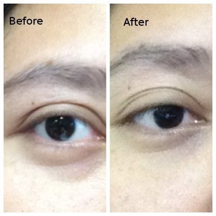 Foto: Before-After Tampilan Kantung Mata