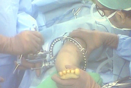 Obesitas, Nabil Sulit Belajar Jalan dan Duduk Hingga Kakinya Berbentuk O