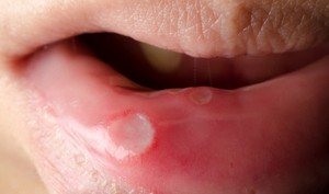 Bukan Cuma karena Kurang Vitamin C, Ini Dia Daftar Penyebab Sariawan