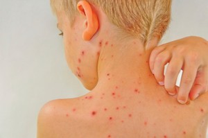 Orang Tua Tak Punya Riwayat Alergi Tapi Anak Bisa Tetap Kena Alergi Lho