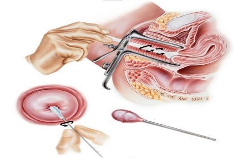 Ingin Skrining Kanker Serviks? Kenali Dulu Metodenya